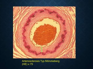 Arteriosclerosis Typ Mönckeberg
(HE) x 75
 
