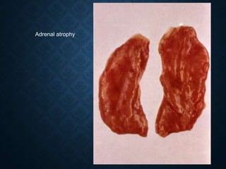 Adrenal atrophy
 
