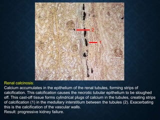 Renal calcinosis:
Calcium accumulates in the epithelium of the renal tubules, forming strips of
calcification. This calcification causes the necrotic tubular epithelium to be sloughed
off. This cast-off tissue forms cylindrical plugs of calcium in the tubules, creating strips
of calcification (1) in the medullary interstitium between the tubules (2). Exacerbating
this is the calcification of the vascular walls.
Result: progressive kidney failure.
1
2
 