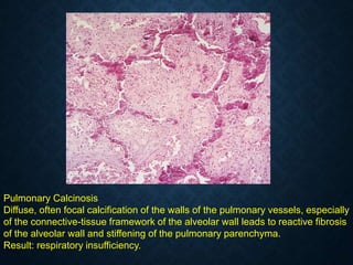 Pulmonary Calcinosis
Diffuse, often focal calcification of the walls of the pulmonary vessels, especially
of the connective-tissue framework of the alveolar wall leads to reactive fibrosis
of the alveolar wall and stiffening of the pulmonary parenchyma.
Result: respiratory insufficiency.
 