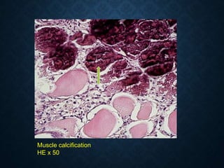 Muscle calcification
HE x 50
 