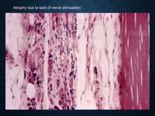 Atrophy due to lack of nerve stimulation
 