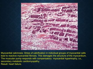 Myocardial calcinosis: Strips of calcification in individual groups of myocardial cells
lead to reactive myocardial fibrosis. This damages the structure of the myocardium.
The muscular pump responds with compensatory myocardial hypertrophy, i.e.,
secondary metabolic cardiomyopathy.
Result: heart failure.
 