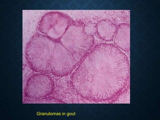Granulomas in gout
 