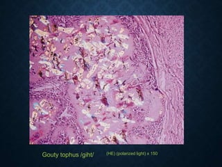 Gouty tophus /giht/ (HE) (polarized light) x 150
 