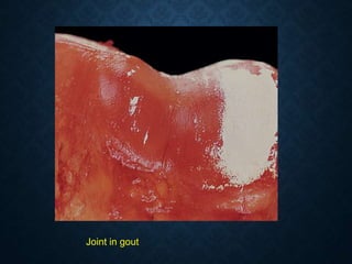 Joint in gout
 
