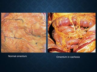 Normal omentum Omentum in cachexia
 