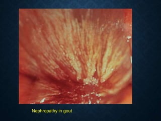 Nephropathy in gout
 