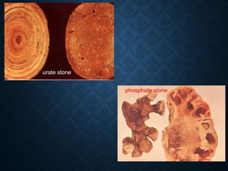 urate stone
phosphate stone
 