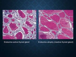 Endocrine active thyroid gland Endocrine atrophy (inactive thyroid gland)
 