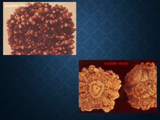 oxalate stone
oxalate stone
 