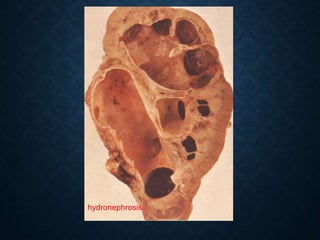 hydronephrosis
 