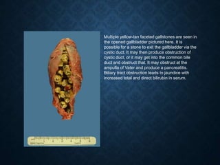 Multiple yellow-tan faceted gallstones are seen in
the opened gallbladder pictured here. It is
possible for a stone to exit the gallbladder via the
cystic duct. It may then produce obstruction of
cystic duct, or it may get into the common bile
duct and obstruct that. It may obstruct at the
ampulla of Vater and produce a pancreatitis.
Biliary tract obstruction leads to jaundice with
increased total and direct bilirubin in serum.
 