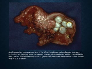 A gallbladder has been opended, and to the left of the pale porcelain gallstones (averaging 1
cm in size) is a fungating mass that extends into the gallbladder lumen and into the gallbladder
wall. This is a primary adenocarcinoma of gallbladder. Gallstones accompany such carcinomas
in up to 90% of cases.
 