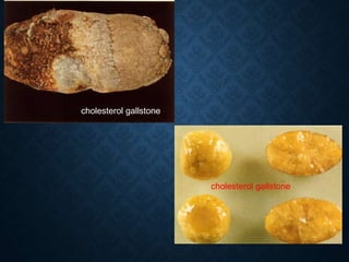 cholesterol gallstone
cholesterol gallstone
 