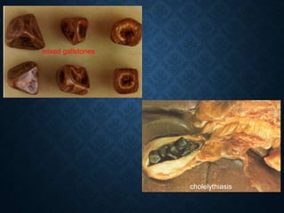mixed gallstones
cholelythiasis
 