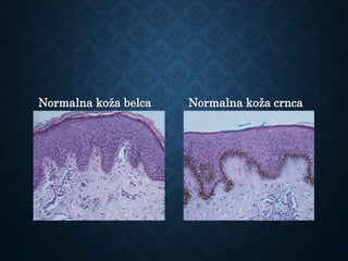 Normalna koža belca Normalna koža crnca
 