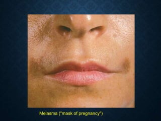 Melasma ("mask of pregnancy")
 
