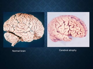 Normal brain Cerebral atrophy
 