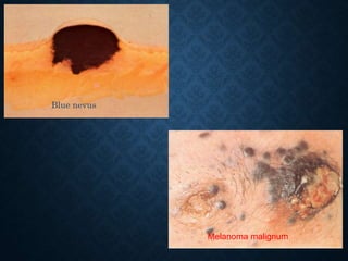 Melanoma malignum
Blue nevus
 
