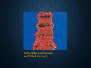 Discopathy in ochronosis
(untreated specimen)
 