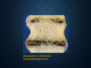 Discopathy in ochronosis
(macerated specimen)
 