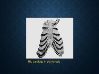 Rib cartilage in ochronosis
 
