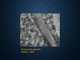 Ochronosis pigment
(TEM) x 1000
 