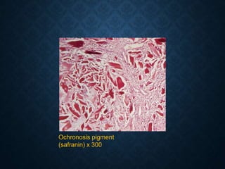 Ochronosis pigment
(safranin) x 300
 