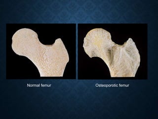 Normal femur Osteoporotic femur
 