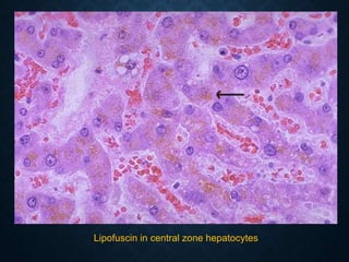 Lipofuscin in central zone hepatocytes
 