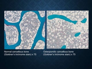 Normal cancellous bone
(Goldner’s trichrome stain) x 75
Osteoporotic cancellous bone
(Goldner’s trichrome stain) x 75
 