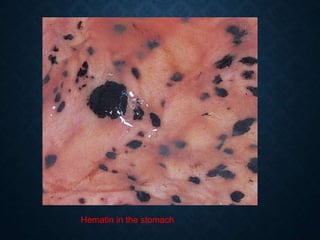 Hematin in the stomach
 