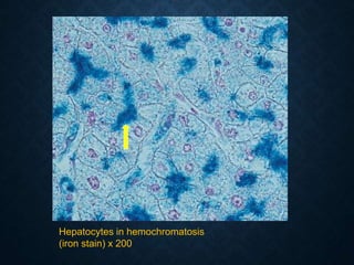 Hepatocytes in hemochromatosis
(iron stain) x 200
 