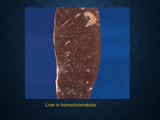 Liver in hemochromatosis
 