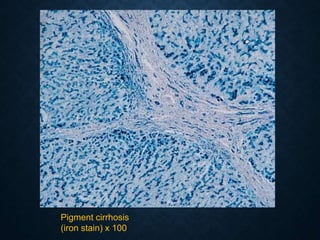 Pigment cirrhosis
(iron stain) x 100
 