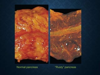 Normal pancreas “Rusty” pancreas
 