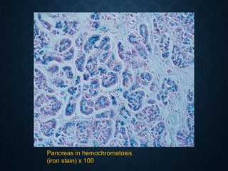 Pancreas in hemochromatosis
(iron stain) x 100
 