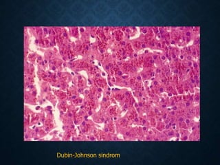Dubin-Johnson sindrom
 