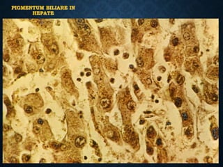 PIGMENTUM BILIARE IN
HEPATE
 