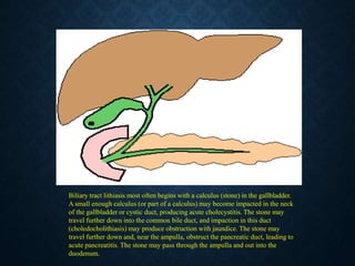 Biliary tract lithiasis most often begins with a calculus (stone) in the gallbladder.
A small enough calculus (or part of a calculus) may become impacted in the neck
of the gallbladder or cystic duct, producing acute cholecystitis. The stone may
travel further down into the common bile duct, and impaction in this duct
(choledocholithiasis) may produce obstruction with jaundice. The stone may
travel further down and, near the ampulla, obstruct the pancreatic duct, leading to
acute pancreatitis. The stone may pass through the ampulla and out into the
duodenum.
 