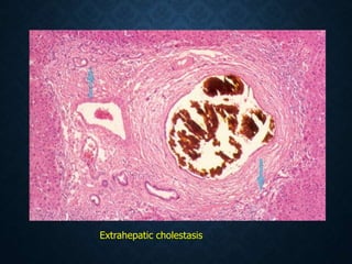 Extrahepatic cholestasis
 