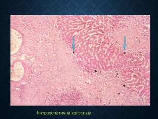 Интрахепатична холестаза
 