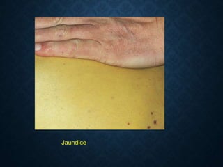 Јaundice
 