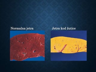 Normalna jetra Jetra kod žutice
 