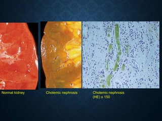 Cholemic nephrosis
(HE) x 150
Normal kidney Cholemic nephrosis
 