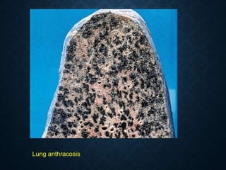 Lung anthracosis
 
