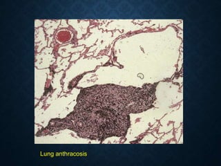Lung anthracosis
 