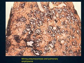 Mining pneumoconiosis and pulmonary
emphysema
 