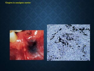 Gingiva in amalgam carrier
Gingiva in amalgam carrier
(HE) x 150
 